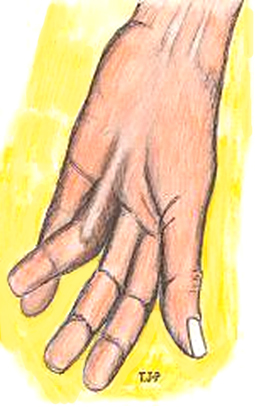 Figure 2 – Corde saillante sous la peau